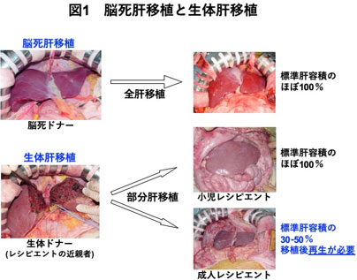 図1　脳死肝移植と生体肝移植